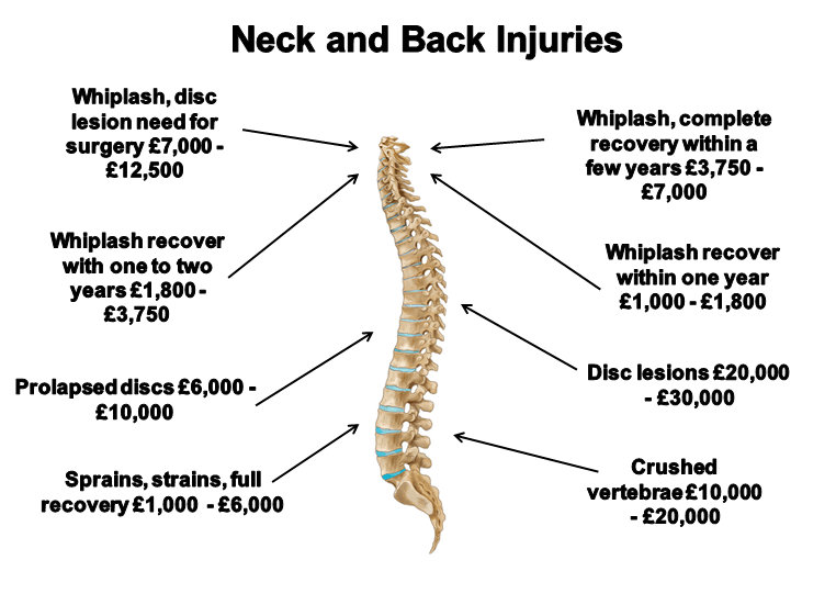 Typical Minimum Payout For a Whiplash Injury